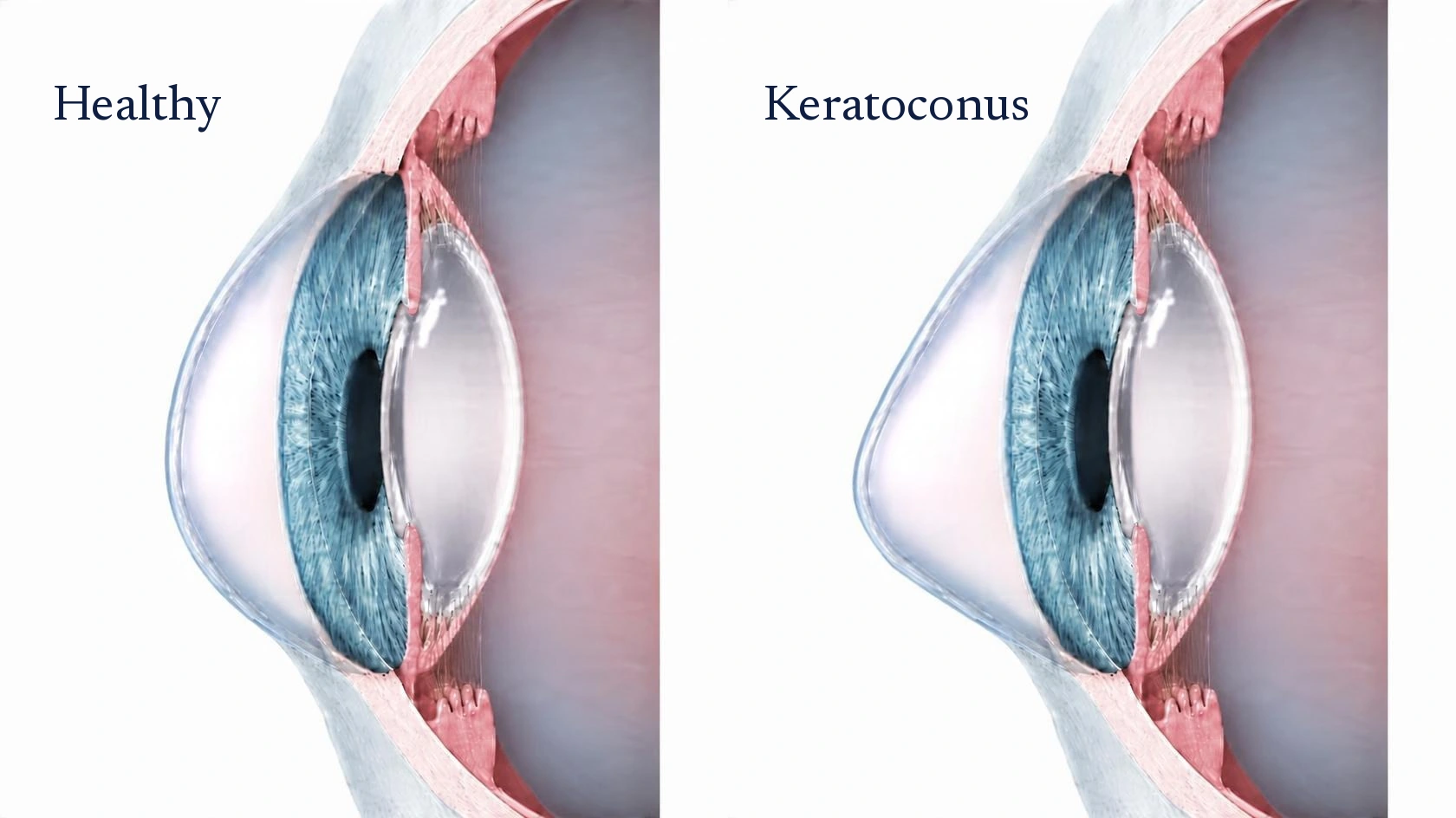 Side view of two corneas: a healthy, evenly curved dome and a thinned cornea bulging forward into a cone